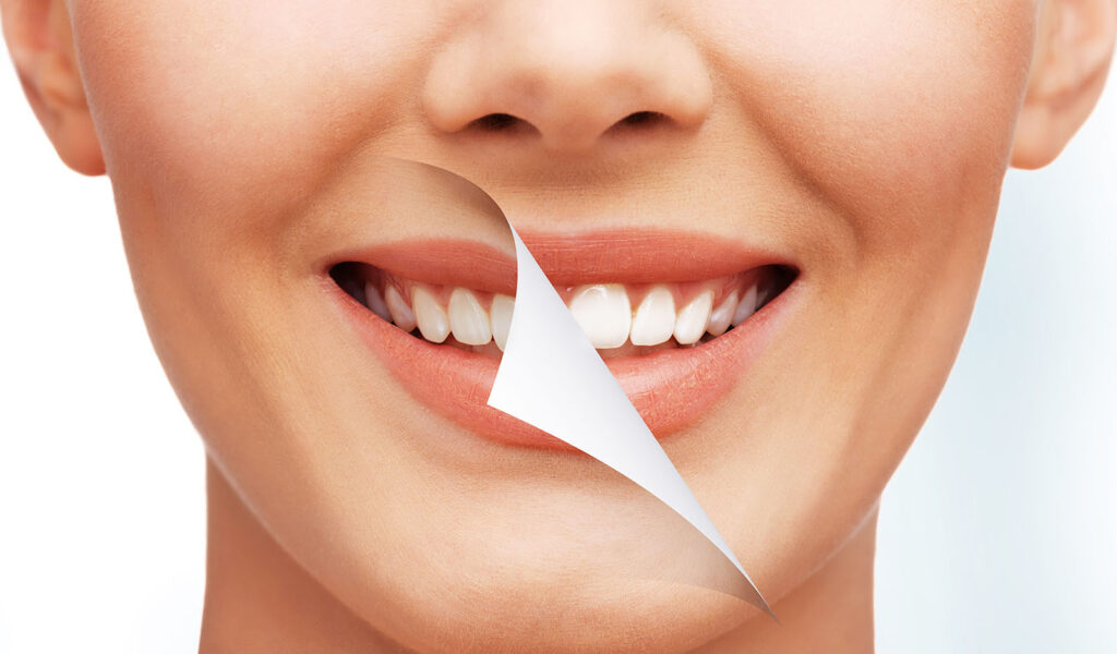 Sbiancamento dentale professionale