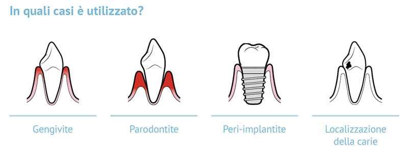 Pulizia denti indolore Vicenza con la Guided Biofilm Therapy (GBT)