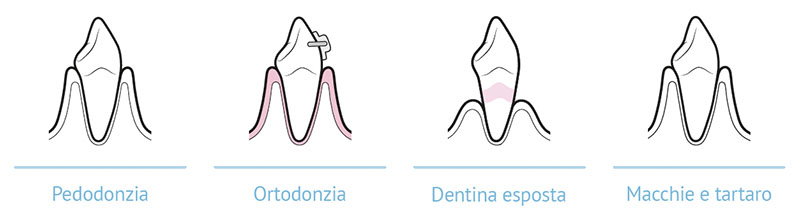 Pulizia denti indolore Vicenza con la Guided Biofilm Therapy (GBT)