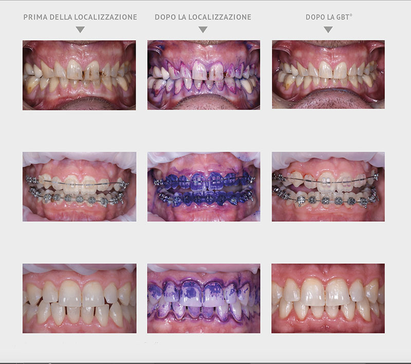 Pulizia denti indolore Vicenza con la Guided Biofilm Therapy (GBT)