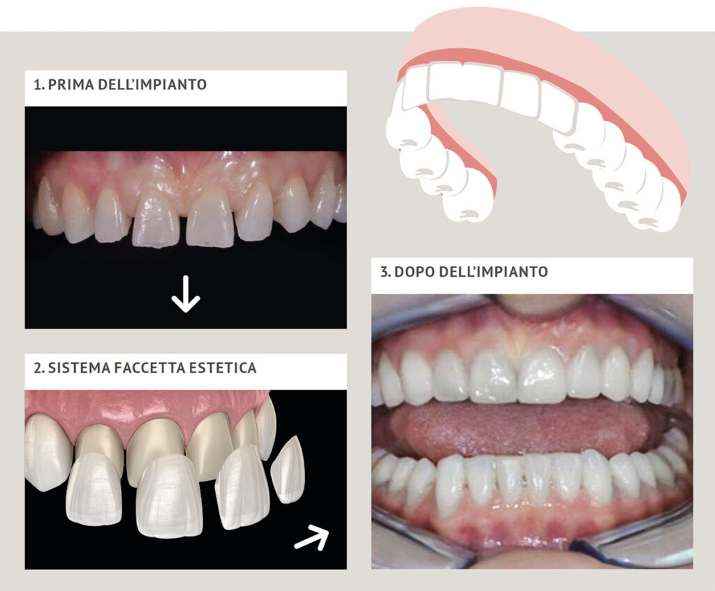 Faccette Dentali e Medicina Estetica