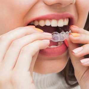 Allineatori Trasparenti come raddrizzare i denti senza che nessuno se ne accorga